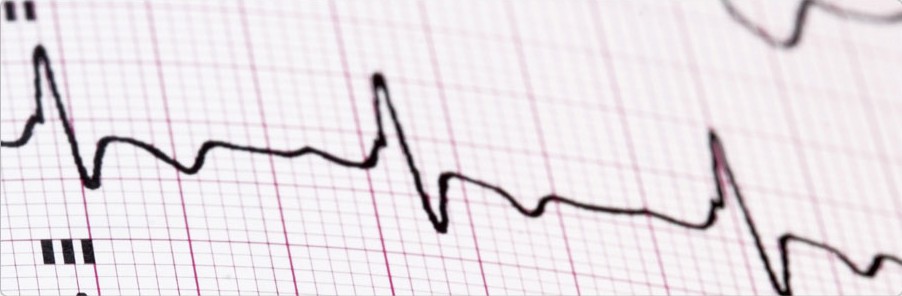 EKG_Electrocardiogram