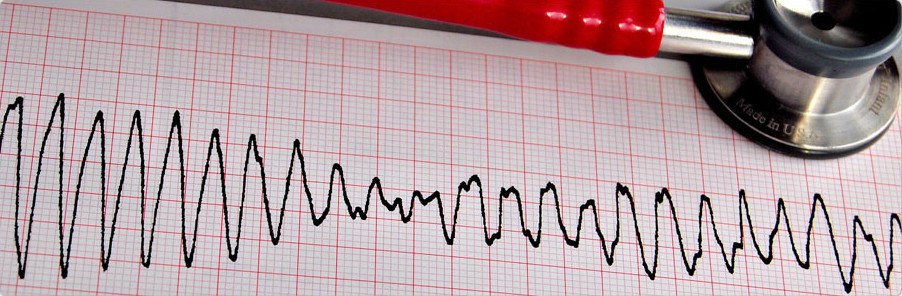 Implantable_Cardioverter_Defibrillator_Analysis-